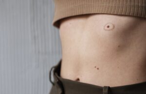 Удаление родинок: безопасно, быстро, без следа